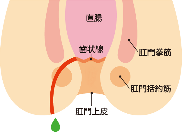 痔ろう