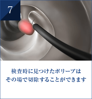 検査時に見つけたポリープは その場で切除することができます