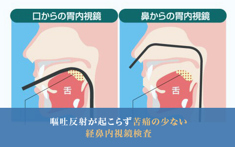 嘔吐反射が起こらず苦痛の少ない経鼻内視鏡検査