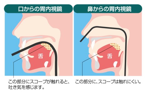 苦しくない経鼻内視鏡